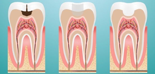 STOMWEB — Циркулярный кариес